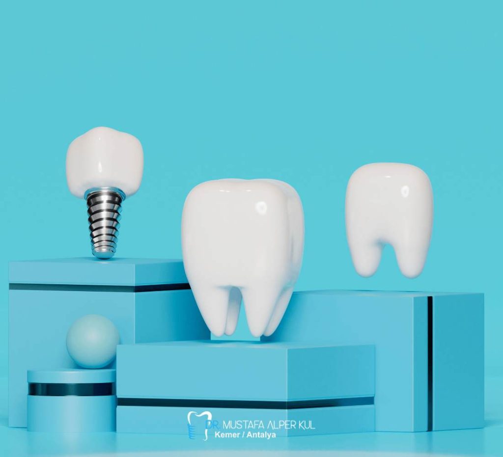 Dental İmplant