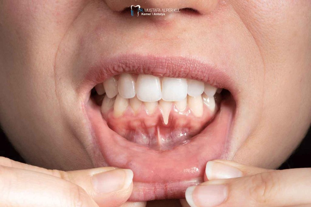 Diş Eti ve Periodontal Tedaviler