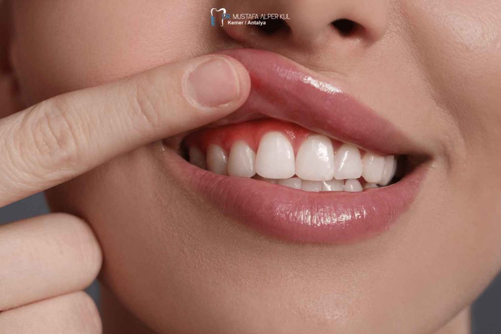 Diş Eti ve Periodontal Tedaviler