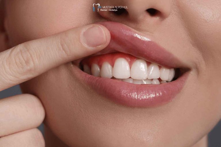 Diş Eti ve Periodontal Tedaviler