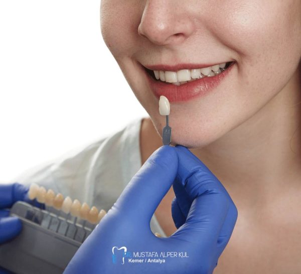 Veneer mi Bonding mi?
